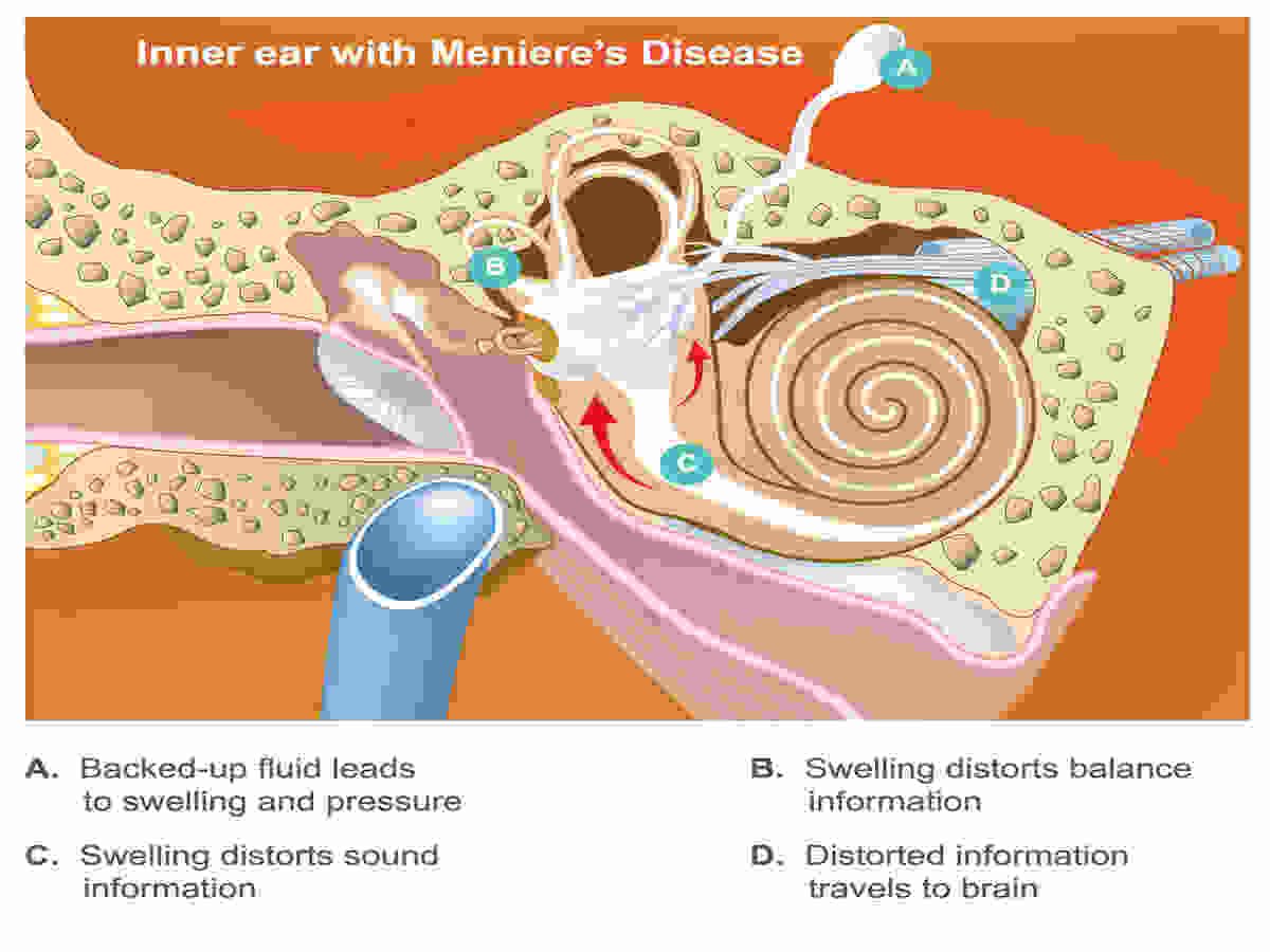Best Key Facts About Meniere’s Disease ICD 10
